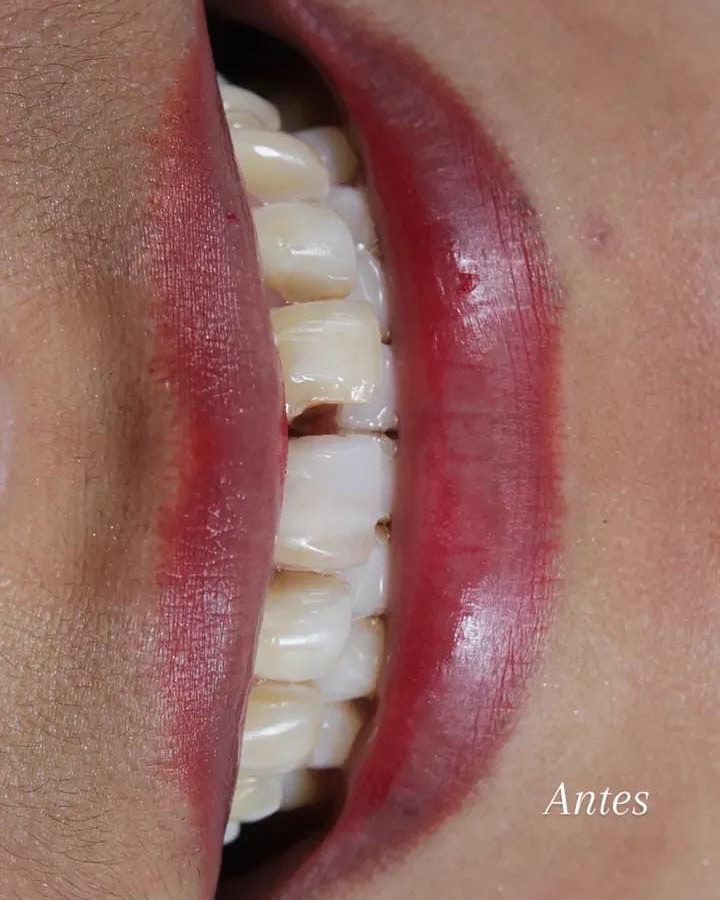 Antes del diseño de sonrisa