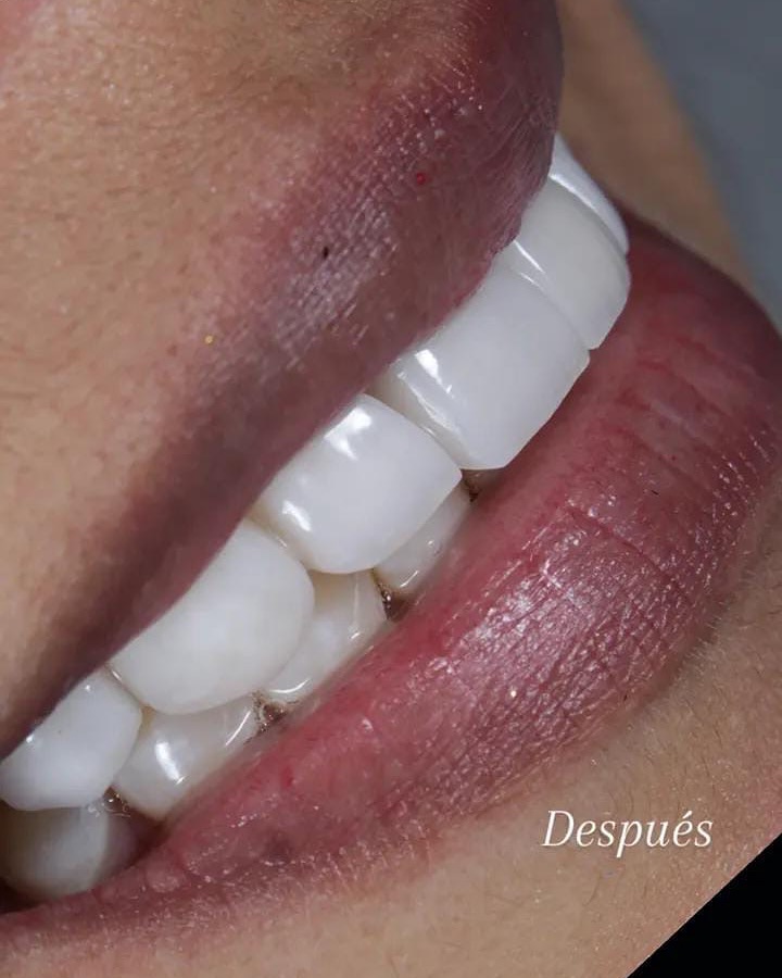 Después del diseño de sonrisa
