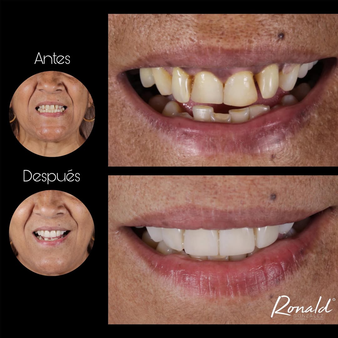Antes y después de transformación completa de sonrisa